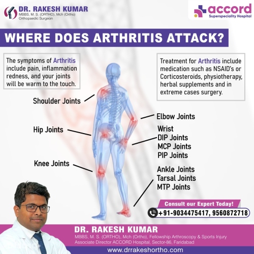 Arthritis-1