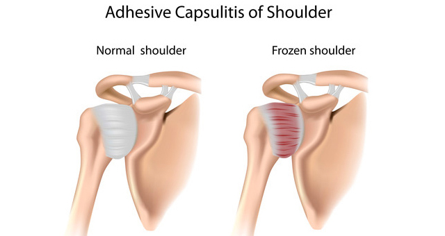 frozen shoulder doctor specialist near me