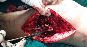 multiligament injury treatment