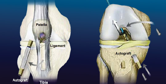 Best ACL Repair Surgeon